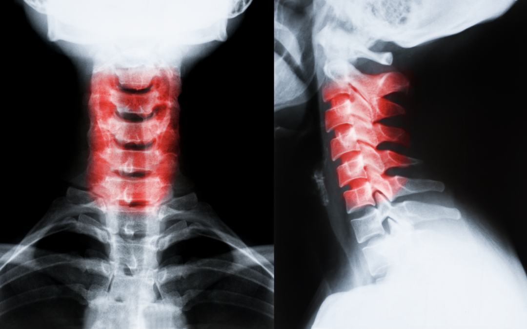 Case Analysis: Car Accident Causes Cervical Surgery